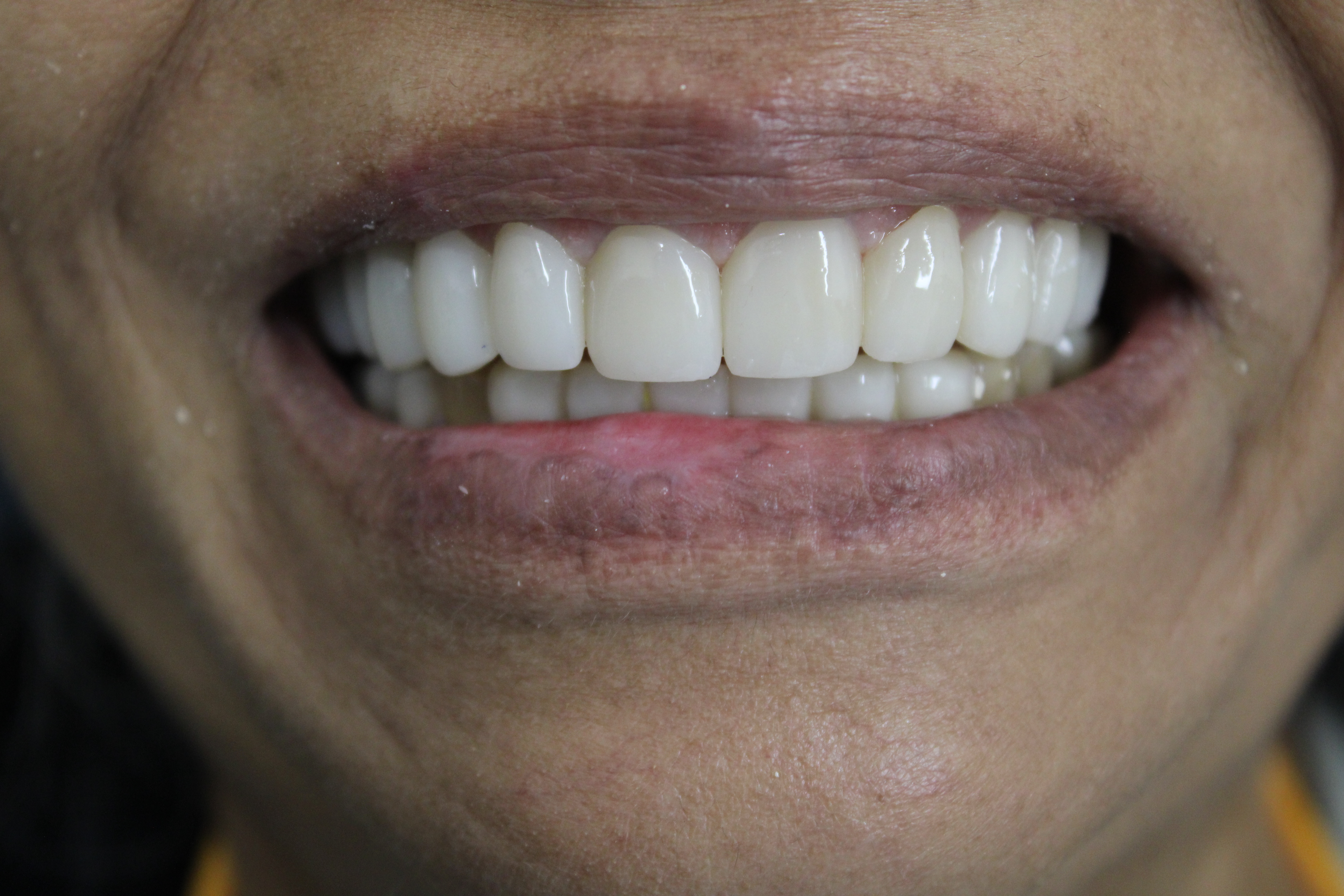 After treatment