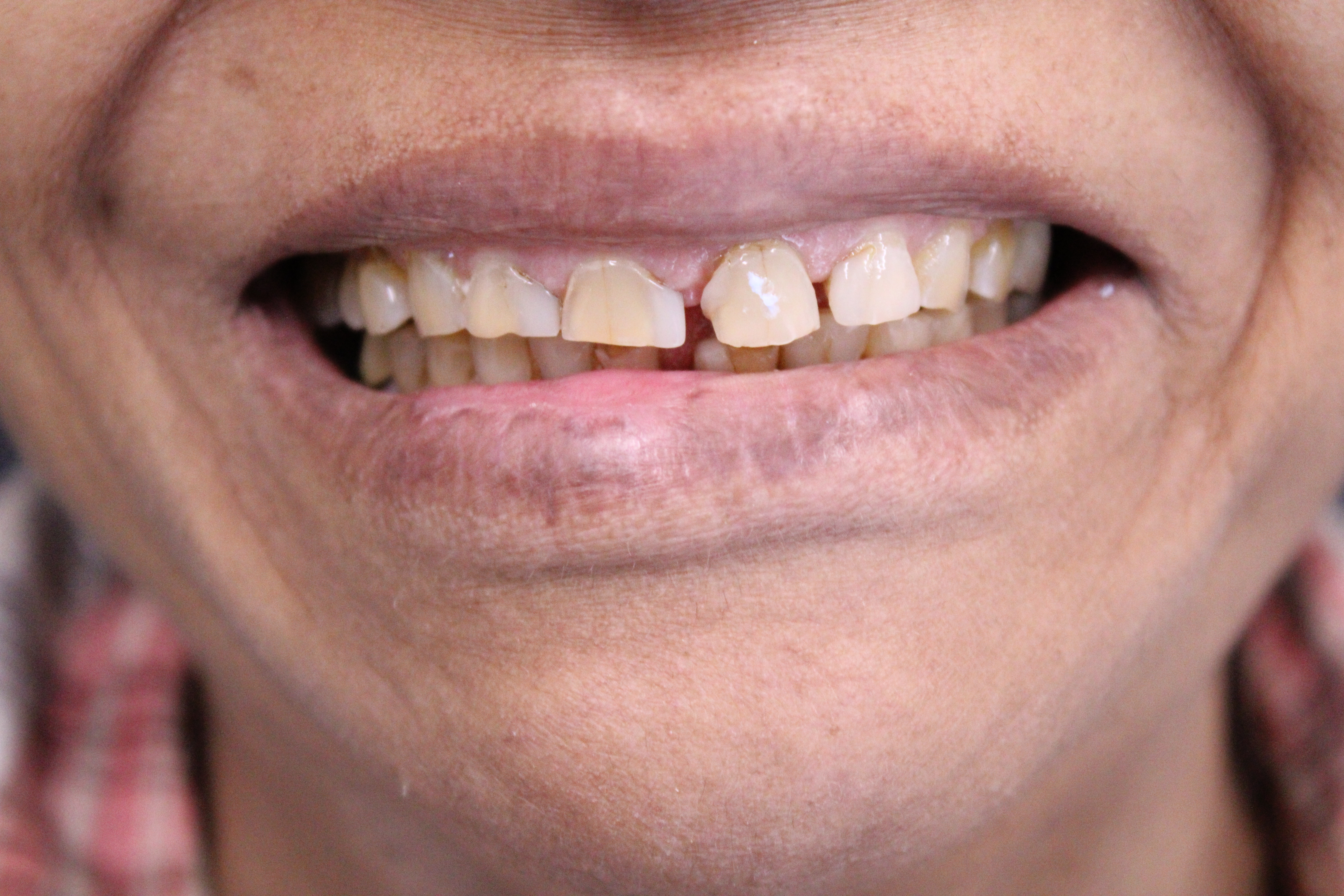 Before treatment
